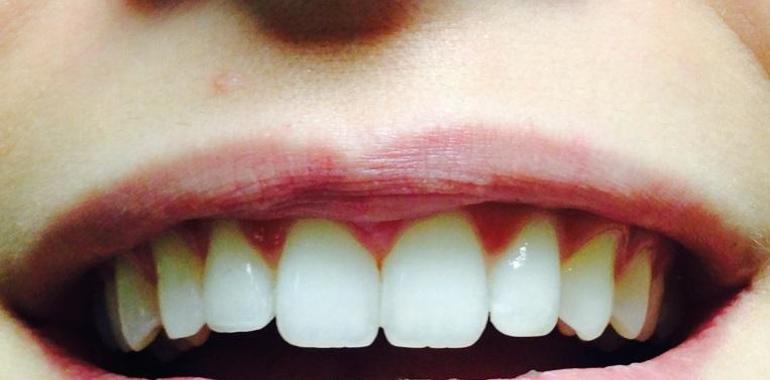 Uno de cada cuatro asturianos no sonríe para ocultar su dentadura