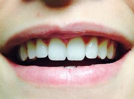 Uno de cada cuatro asturianos no sonríe para ocultar su dentadura