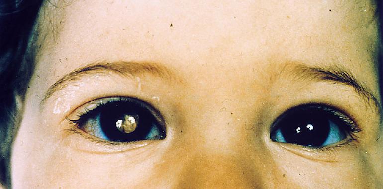 Un fármaco biológico mejora el tratamiento de cáncer de retina en niños