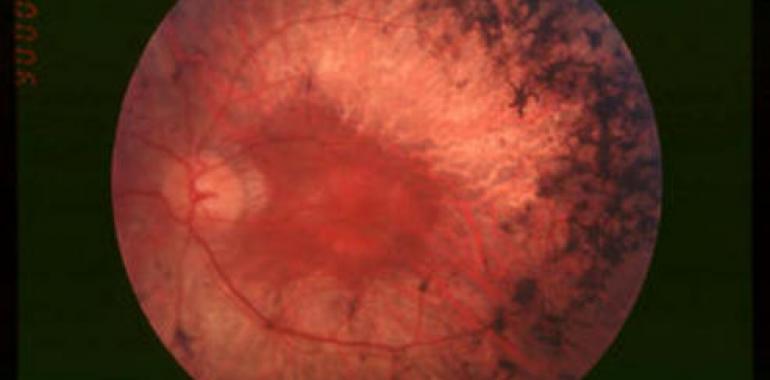 Nueva técnica para avanzar en el estudio de la retinosis pigmentaria