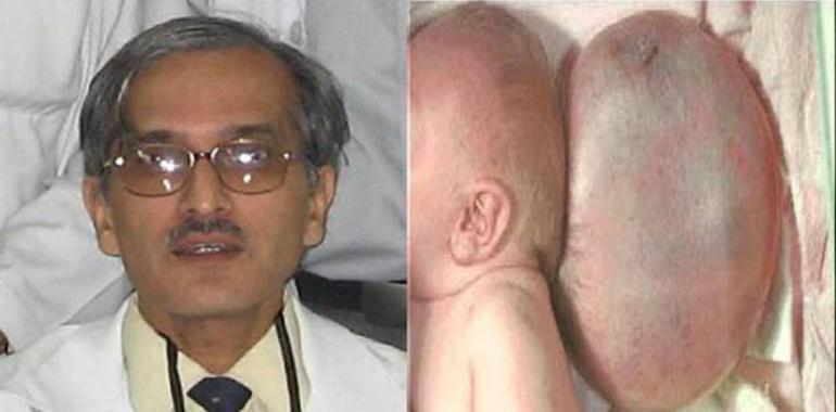 Médicos indios eliminan con éxito una protuberancia gigante en la cabeza de un bebé