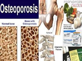 50 per cent of Indian population to be victim of Osteoporosis by next decade