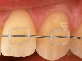 Nanopartículas para reforzar los \brackets\ transparentes de las ortodoncias