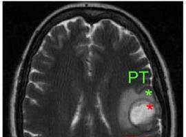 Identificados dos tipos de células iniciadoras de los tumores cerebrales más agresivos