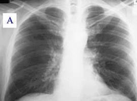 Llamazares pregunta al Gobierno por qué no incluye el cribado de cáncer de pulmón en la Sanidad