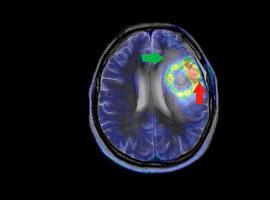 Un algoritmo delimita automáticamente tumores cerebrales en imágenes médicas