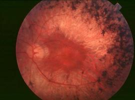 Investigación pionera contra la retinosis pigmentaria