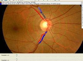 Nuevo método para detectar enfermedades analizando la retina
