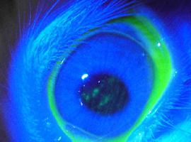 Primer implante de una córnea artificial en un enfermo con una grave patología ocular 
