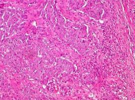 Instituto de Oncología de Asturias participa del desarrollo de un biomarcador en cáncer de colon