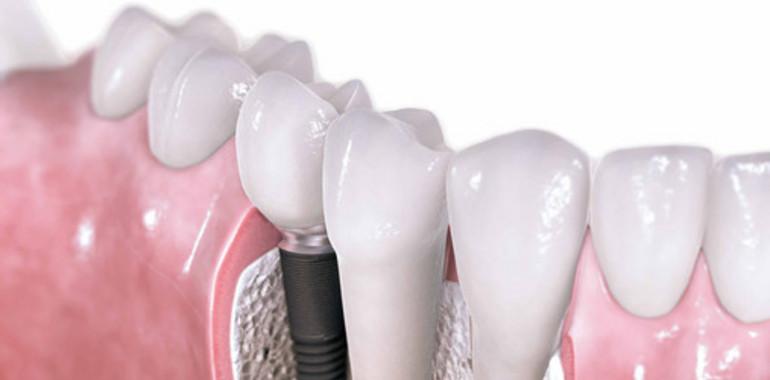 Nueva tecnología mejora recubrimiento en implantes dentales