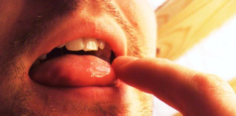 El 85% de los casos de cáncer oral se diagnostican de manera tardía