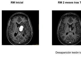 Valdecilla: Radiocirugía en tumores y anormalidades funcionales cerebrales