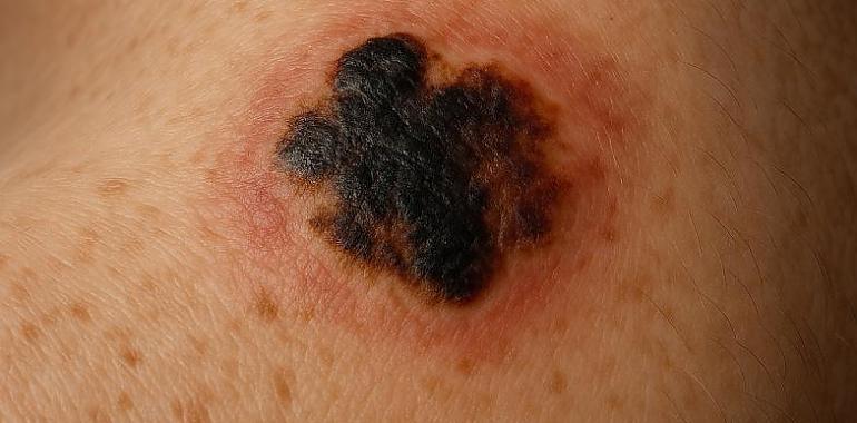 El cáncer de piel se dispara en Asturias: la Asociación Española Contra el Cáncer clama por una prevención urgente y constante