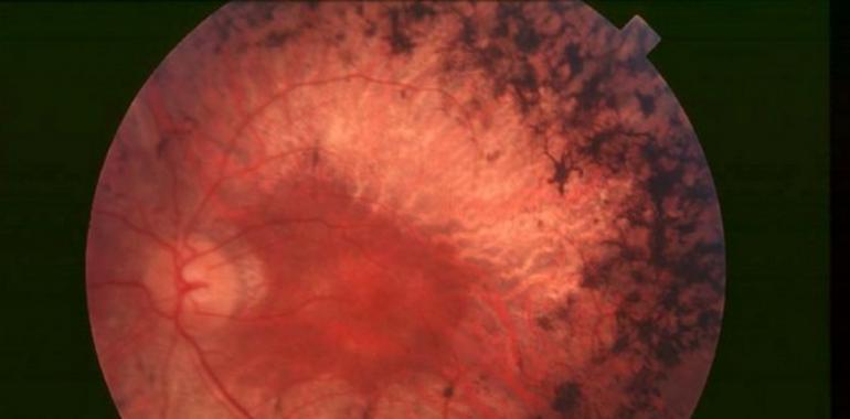 Investigación pionera contra la retinosis pigmentaria