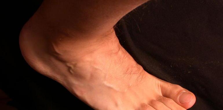 Nanomedicina para las úlceras del pie diabético