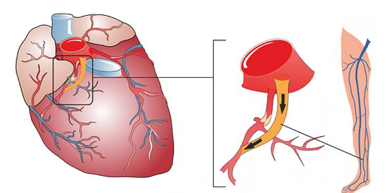 Dicen que los infartos te pillan siempre desprevenido... ¿pero sabes que 8 de cada 10 se pueden prevenir