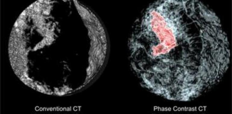 El equipo del doctor Vizoso relaciona el perfil inflamatorio de los tumores de mama con su metástasis