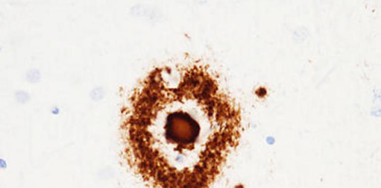 Confirman la relación entre una proteína proinflamatoria y el alzhéimer