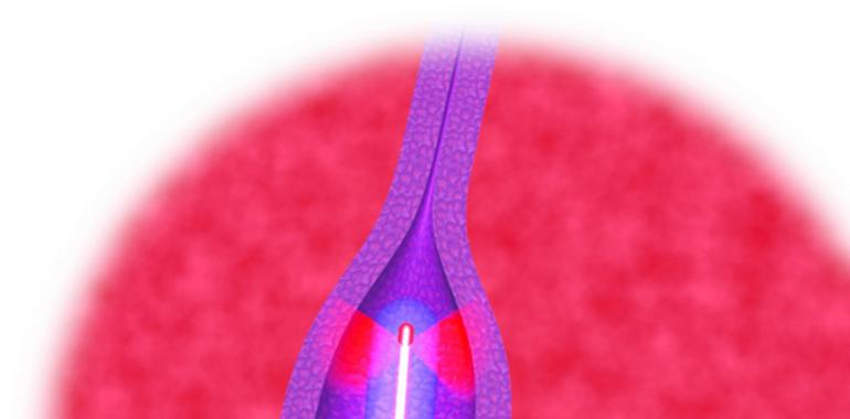 Novedoso tratamiento en Valvuloplastia con un láser de biolitec