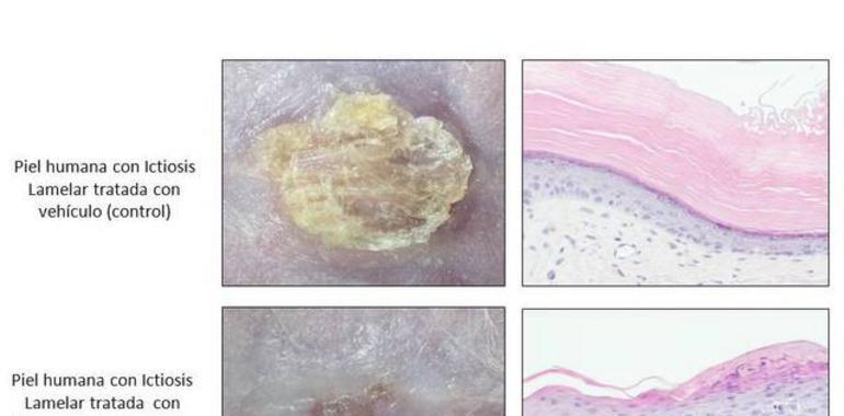 Un posible tratamiento para la Ictiosis lamelar