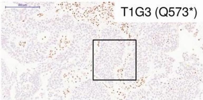 Secuenciado en España el exoma del cáncer de vejiga más frecuente