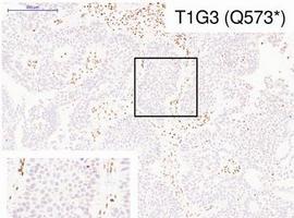 Secuenciado en España el exoma del cáncer de vejiga más frecuente