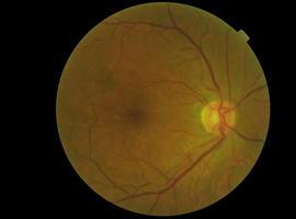 Teleoftalmología para prevenir la retinopatía diabética