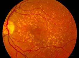 Nuevas investigaciones en torno al #edema #macular #diabético