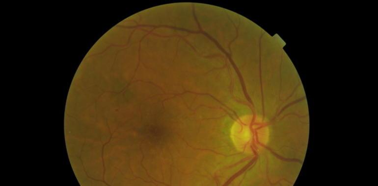 Programa de detección de la #retinopatía #diabética en el centro de salud de El Natahoyo