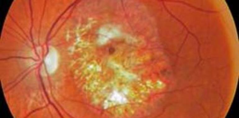 #Degeneración #macular asociada a la edad: Un reto para el futuro. #Conferencia #Gijón