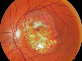 #Degeneración #macular asociada a la edad: Un reto para el futuro. #Conferencia #Gijón