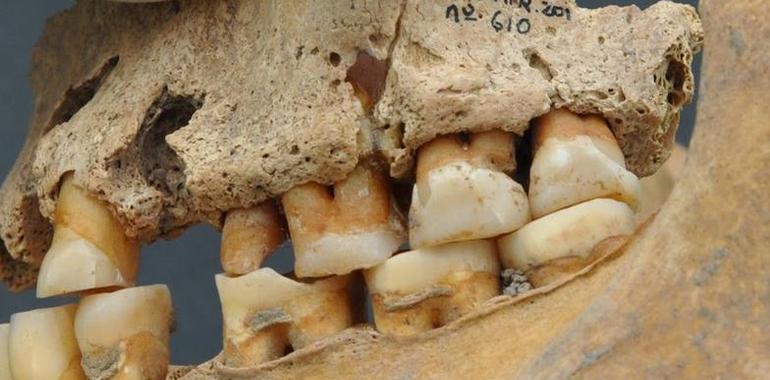 Hallado en Atapuerca un homínido con un molar de más