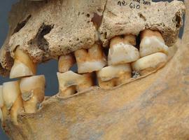 Hallado en Atapuerca un homínido con un molar de más