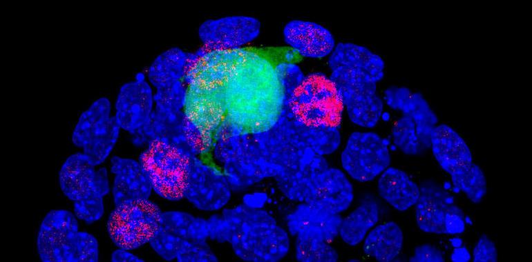 Células madre pluripotentes como posible terapia para alzhéimer, párkinson e infarto cerebral