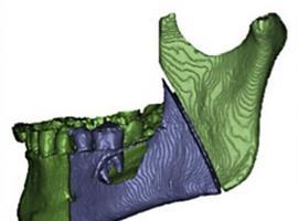 La impresión 3D podría resolver problemas maxilofaciales graves 