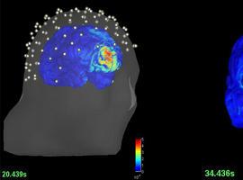 Nuevo modo de detectar epilepsia sin intervención quirúrgica