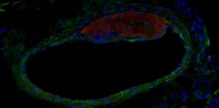 Hallada una nueva molécula eficaz contra la aterosclerosis