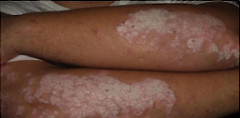 Dermatólogos de Asturias se reúnen para avanzar en el abordaje de la psoriasis 