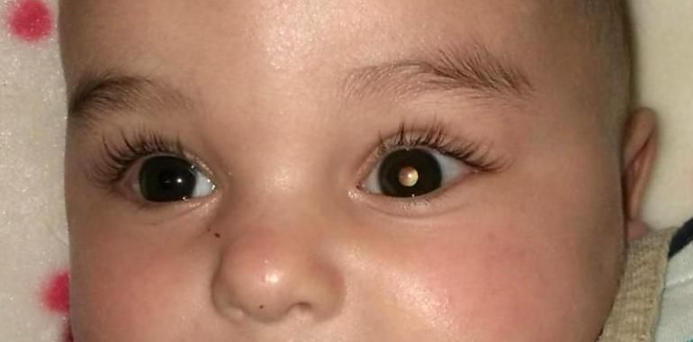 Tratan por primera vez en el mundo un retinoblastoma pediátrico con un virus oncolítico