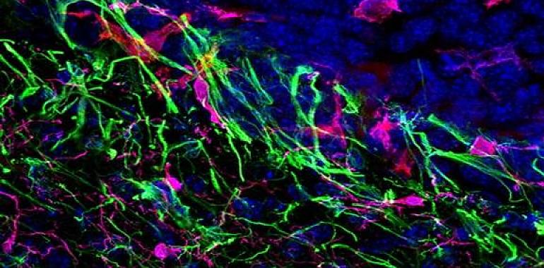 Metástasis: el peligroso viaje del cáncer hacia otros órganos y tejidos