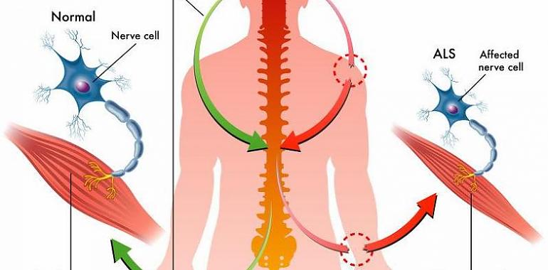 1,8 millones de euros para mejorar el cuidado de personas con ELA