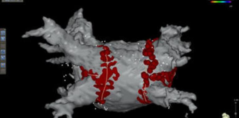 Demuestran la eficacia de la cirugía para tratar la fibrilación auricular