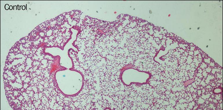 Un fármaco antitumoral previene el desarrollo de la fibrosis pulmonar 