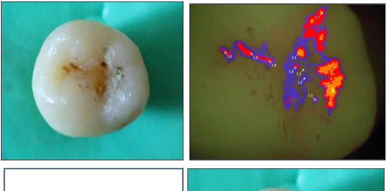 Nuevas tecnologías para el diagnóstico temprano de caries