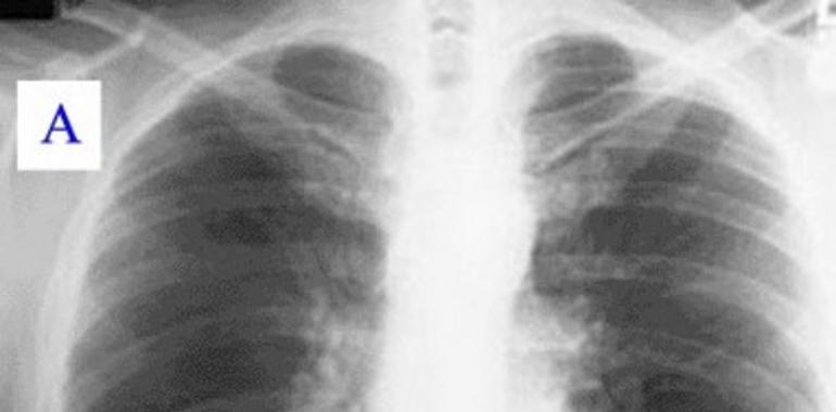 Llamazares pregunta al Gobierno por qué no incluye el cribado de cáncer de pulmón en la Sanidad